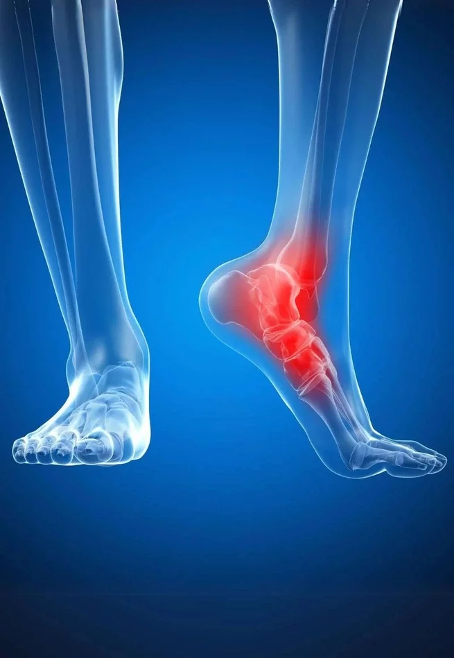 X-ray illustration of two feet, one highlighting the bones of the midfoot and ankle